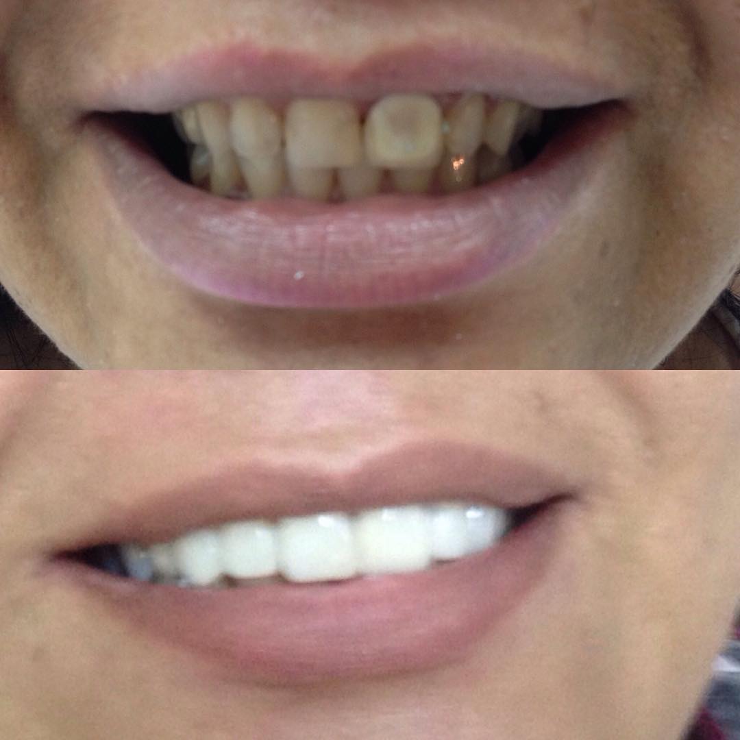 Transformação do Sorriso — antes e depois